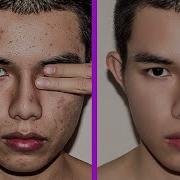 How To Remove Acne Pimples In Photoshop 7 0