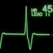 Ассelerated Ventricular Rhythm Avr