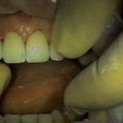 Complex Restorative Dentistry Case Part 2