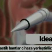 Hemoroid Için Boğma Tedavisi Bant Ligasyon