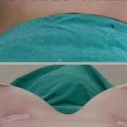 Məmə Böyütmə Breast Augmentation