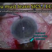 Extracapsular Extraction